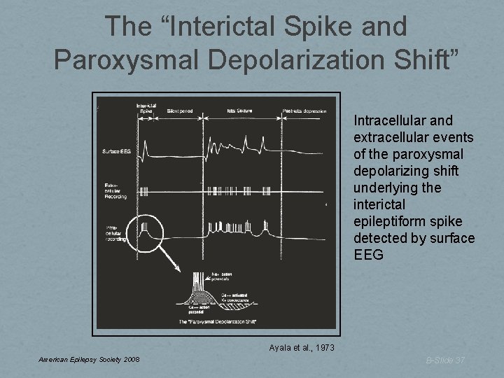 The “Interictal Spike and Paroxysmal Depolarization Shift” Intracellular and extracellular events of the paroxysmal