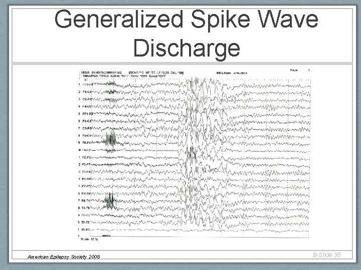 Generalized Spike Wave Discharge American Epilepsy Society 2008 B-Slide 38 