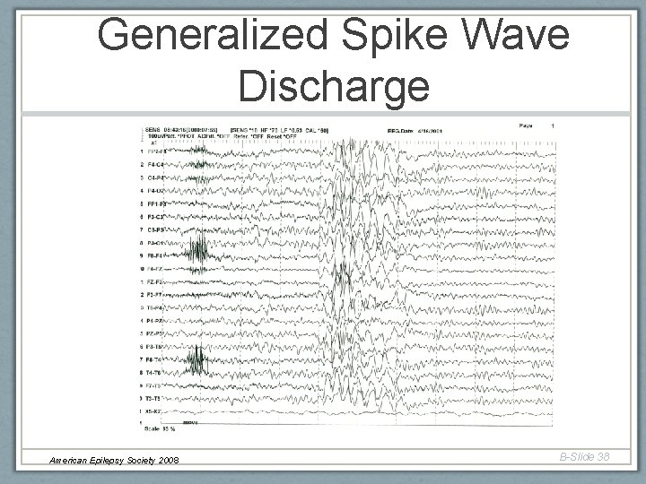 Generalized Spike Wave Discharge American Epilepsy Society 2008 B-Slide 38 Generalized Spike Wave Discharge American Epilepsy Society 2008 B-Slide 38