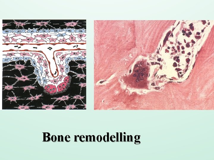 Bone remodelling 