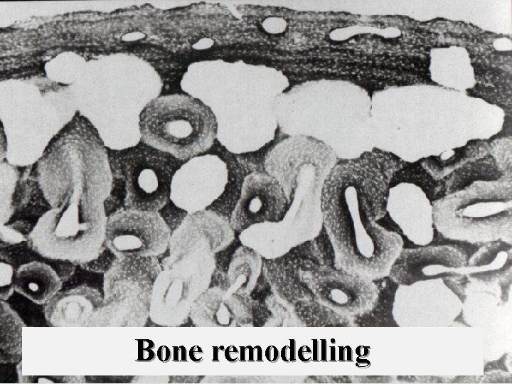 Bone remodelling 