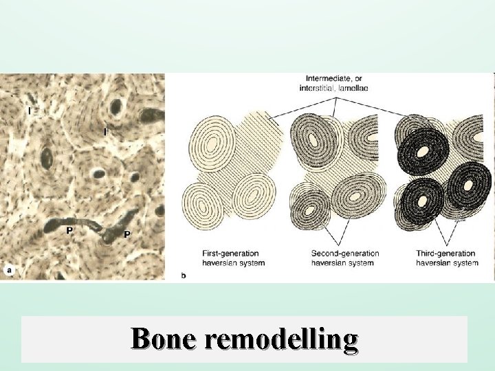 Bone remodelling 