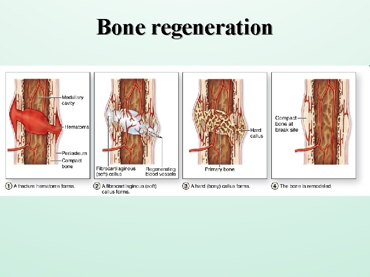 Bone regeneration 