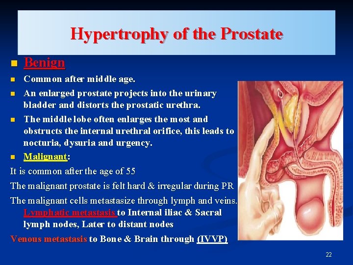 Hypertrophy of the Prostate n Benign Common after middle age. n An enlarged prostate
