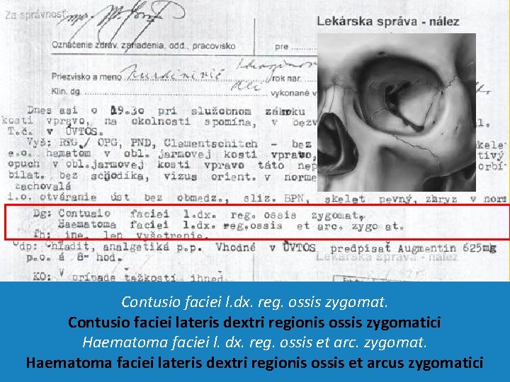 Contusio faciei l. dx. reg. ossis zygomat. Contusio faciei lateris dextri regionis ossis zygomatici