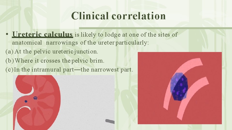Clinical correlation • Ureteric calculus is likely to lodge at one of the sites