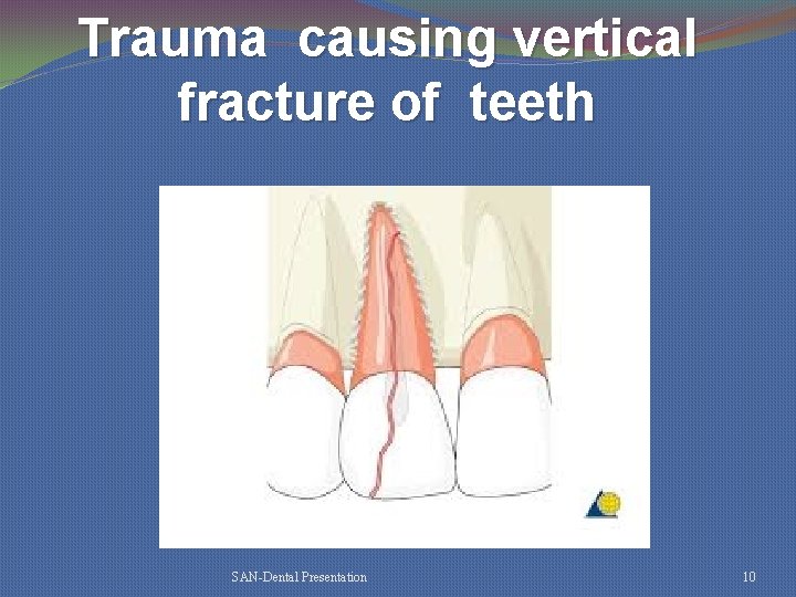 Trauma causing vertical fracture of teeth SAN-Dental Presentation 10 