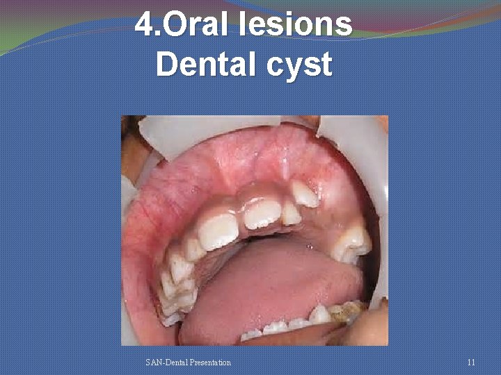 4. Oral lesions Dental cyst SAN-Dental Presentation 11 