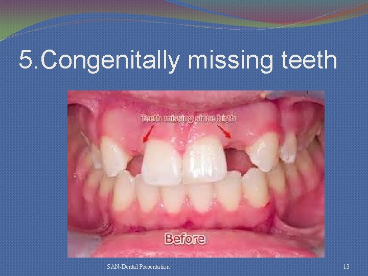 5. Congenitally missing teeth SAN-Dental Presentation 13 