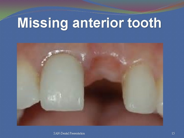 Missing anterior tooth SAN-Dental Presentation 15 