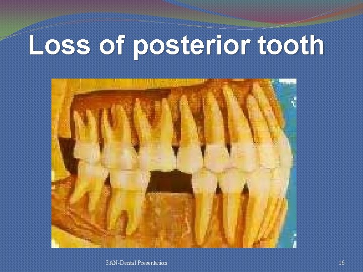 Loss of posterior tooth SAN-Dental Presentation 16 