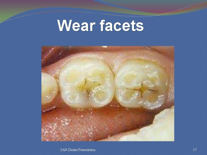 Wear facets SAN-Dental Presentation 17 