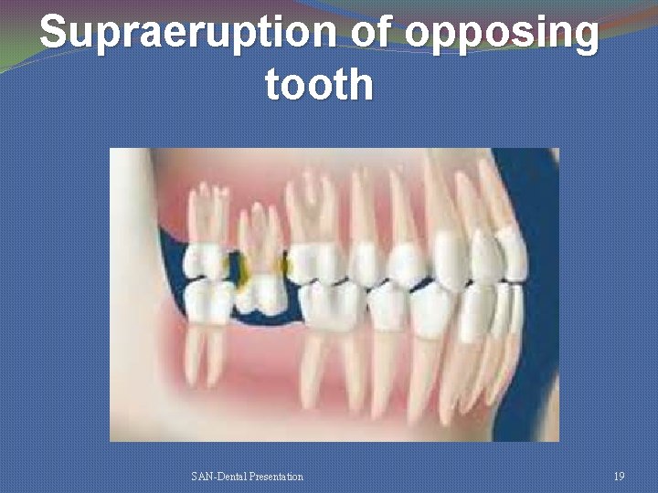 Supraeruption of opposing tooth SAN-Dental Presentation 19 