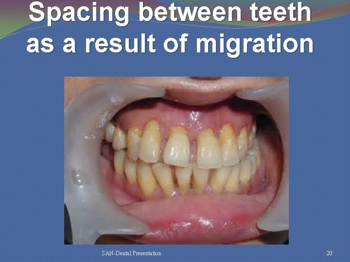 Spacing between teeth as a result of migration SAN-Dental Presentation 20 