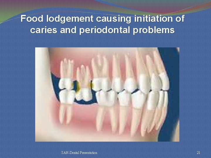 Food lodgement causing initiation of caries and periodontal problems SAN-Dental Presentation 21 