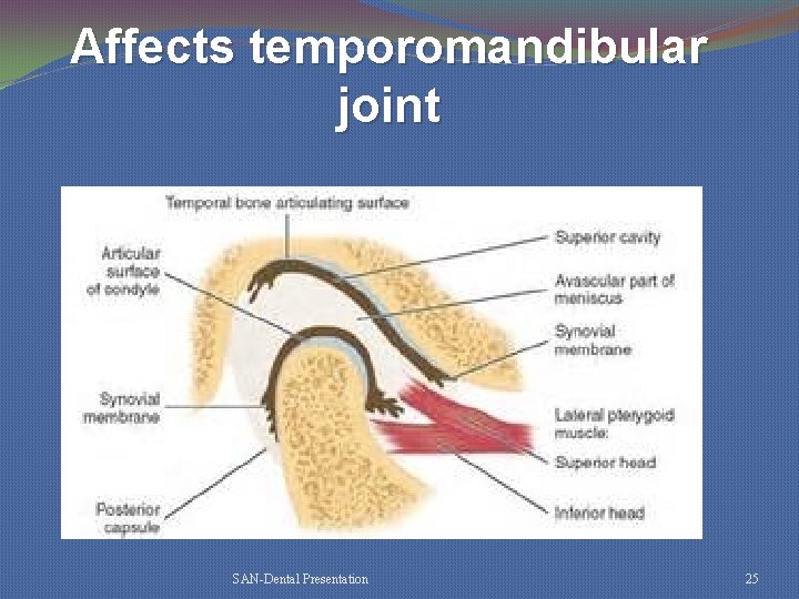 Affects temporomandibular joint SAN-Dental Presentation 25 