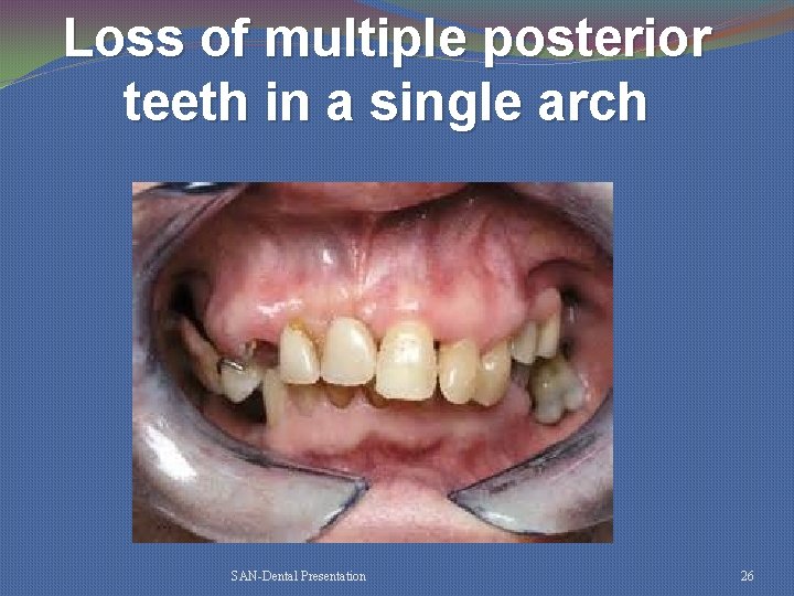 Loss of multiple posterior teeth in a single arch SAN-Dental Presentation 26 