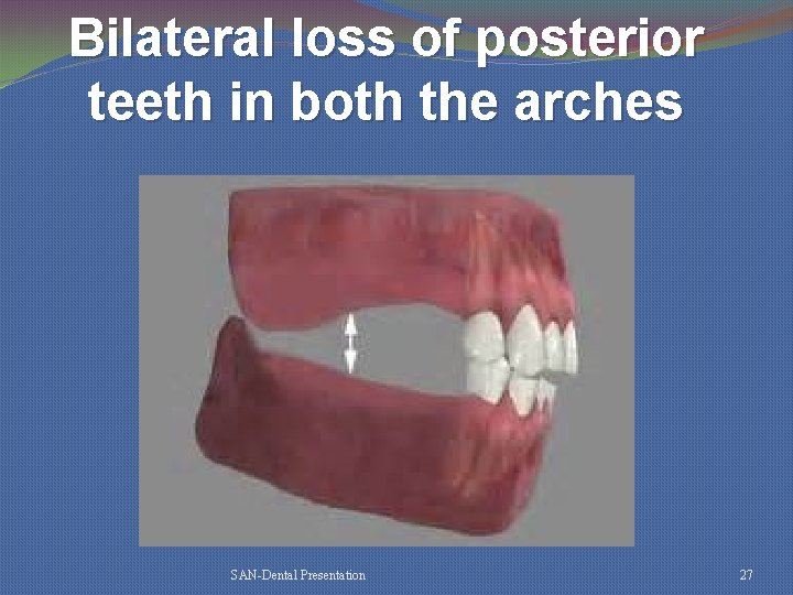 Bilateral loss of posterior teeth in both the arches SAN-Dental Presentation 27 