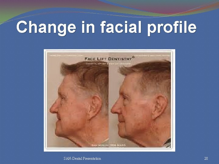 Change in facial profile SAN-Dental Presentation 28 