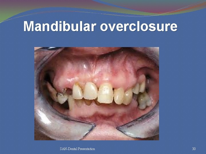 Mandibular overclosure SAN-Dental Presentation 30 