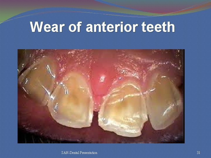 Wear of anterior teeth SAN-Dental Presentation 31 