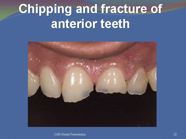 Chipping and fracture of anterior teeth SAN-Dental Presentation 32 