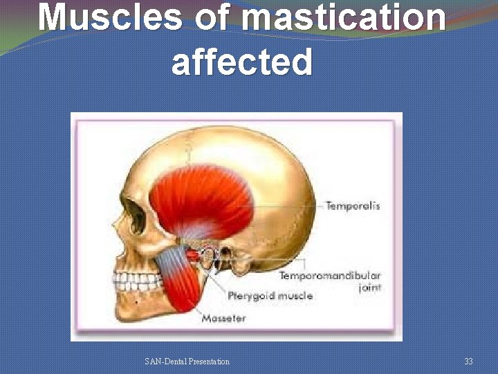 Muscles of mastication affected SAN-Dental Presentation 33 