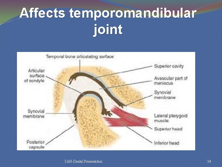 Affects temporomandibular joint SAN-Dental Presentation 34 