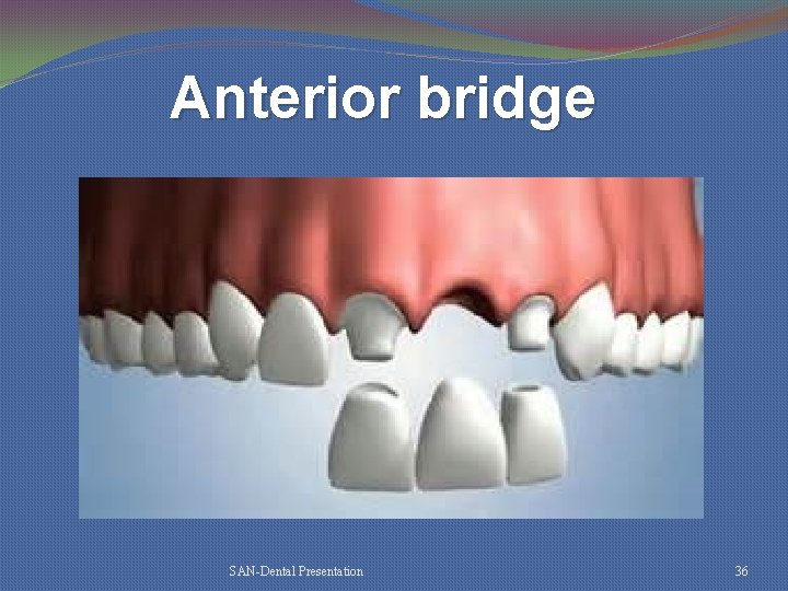 Anterior bridge SAN-Dental Presentation 36 