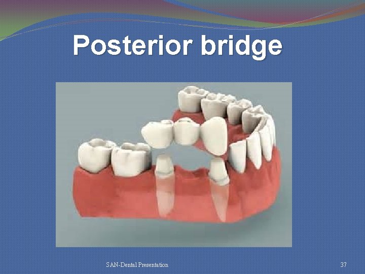 Posterior bridge SAN-Dental Presentation 37 