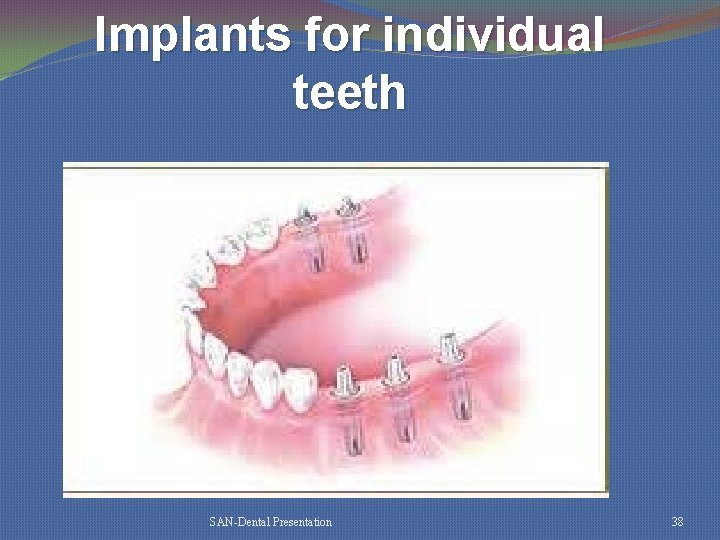 Implants for individual teeth SAN-Dental Presentation 38 