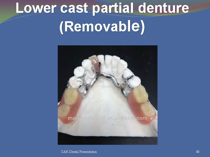 Lower cast partial denture (Removable) SAN-Dental Presentation 40 