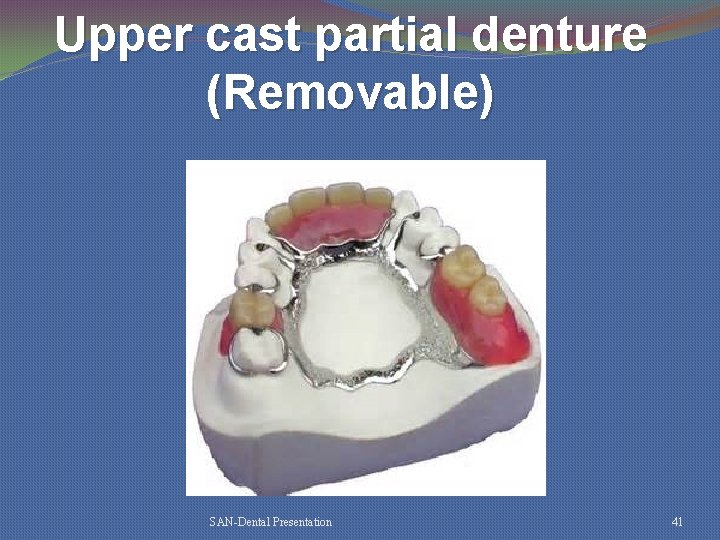 Upper cast partial denture (Removable) SAN-Dental Presentation 41 