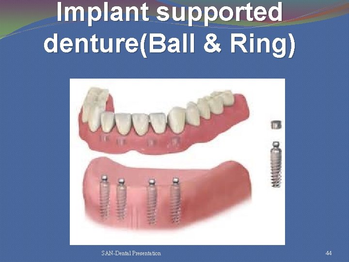 Implant supported denture(Ball & Ring) SAN-Dental Presentation 44 