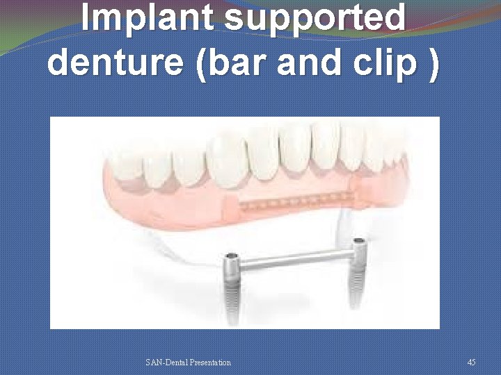 Implant supported denture (bar and clip ) SAN-Dental Presentation 45 