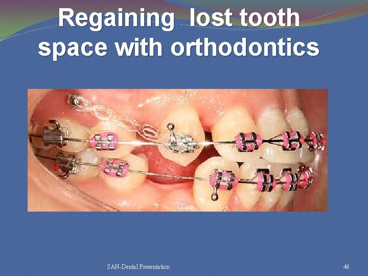 Regaining lost tooth space with orthodontics SAN-Dental Presentation 46 