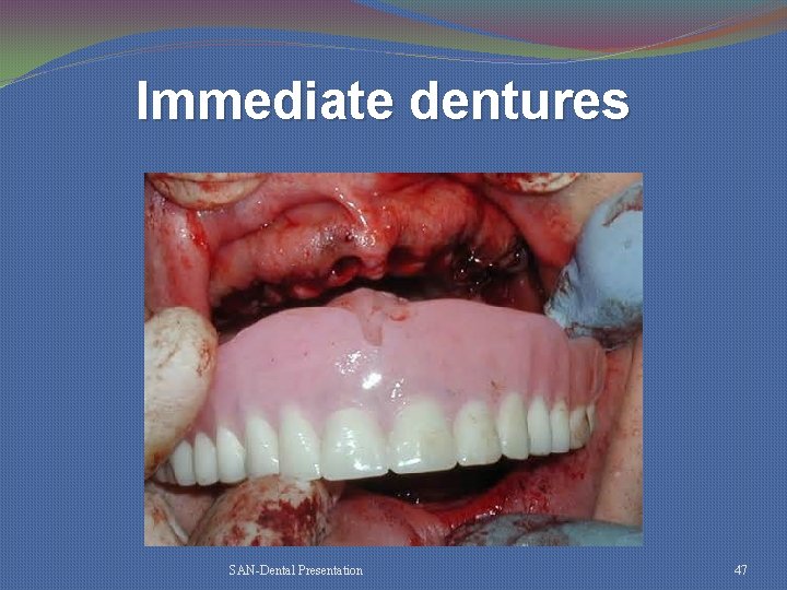 Immediate dentures SAN-Dental Presentation 47 
