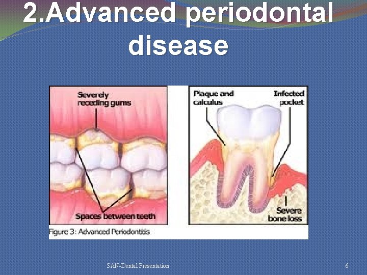 2. Advanced periodontal disease SAN-Dental Presentation 6 