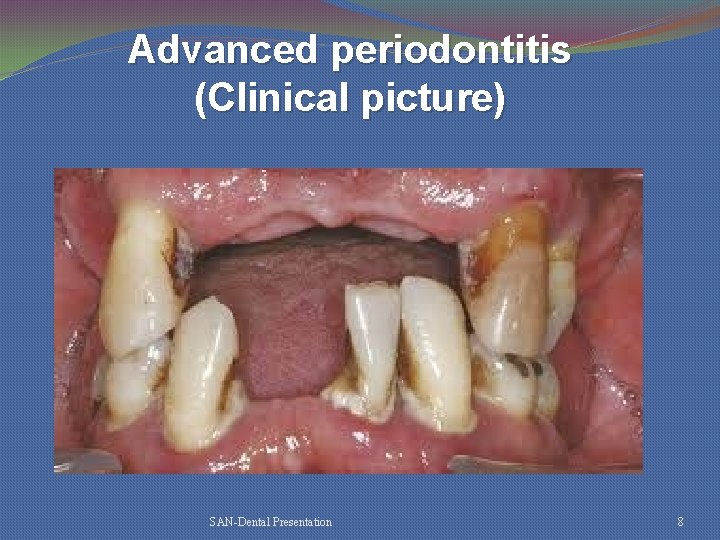 Advanced periodontitis (Clinical picture) SAN-Dental Presentation 8 