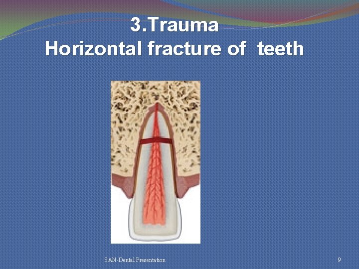 3. Trauma Horizontal fracture of teeth SAN-Dental Presentation 9 