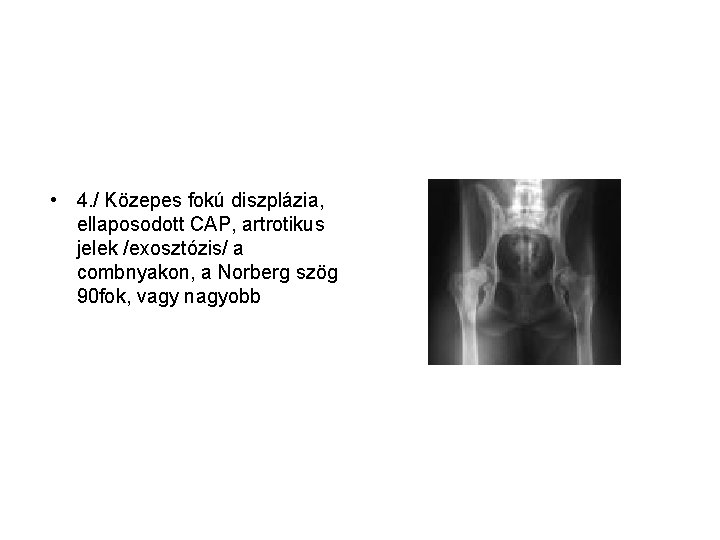  • 4. / Közepes fokú diszplázia, ellaposodott CAP, artrotikus jelek /exosztózis/ a combnyakon,