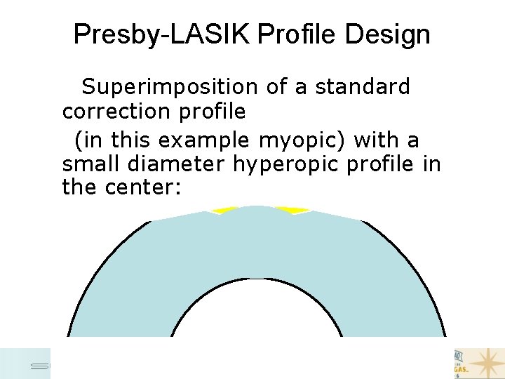 Presby-LASIK Profile Design Superimposition of a standard correction profile (in this example myopic) with