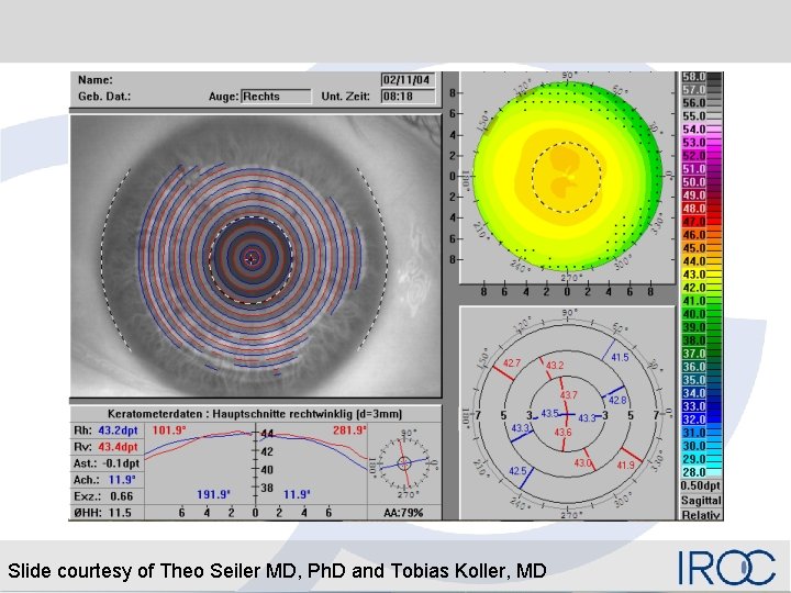 Slide courtesy of Theo Seiler MD, Ph. D and Tobias Koller, MD 