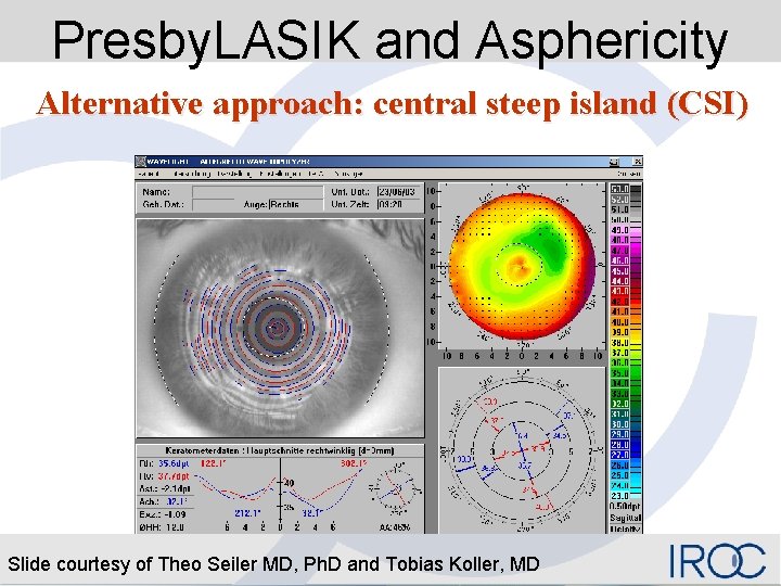 Presby. LASIK and Asphericity Alternative approach: central steep island (CSI) Slide courtesy of Theo
