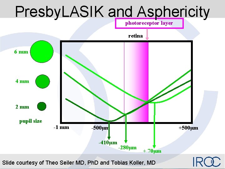 Presby. LASIK and Asphericity photoreceptor layer retina 6 mm 4 mm 2 mm pupil