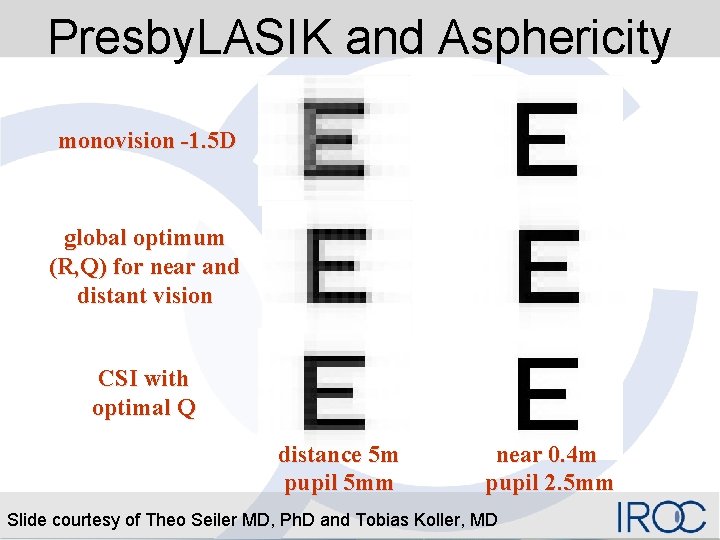 Presby. LASIK and Asphericity monovision -1. 5 D global optimum (R, Q) for near
