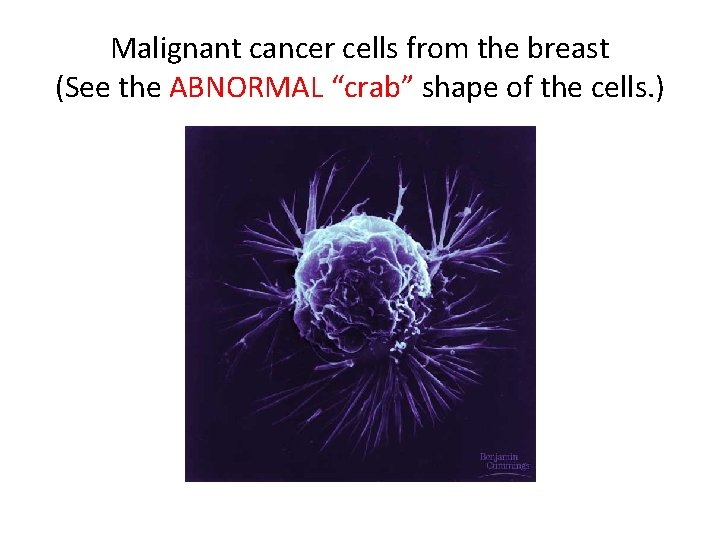 Malignant cancer cells from the breast (See the ABNORMAL “crab” shape of the cells.