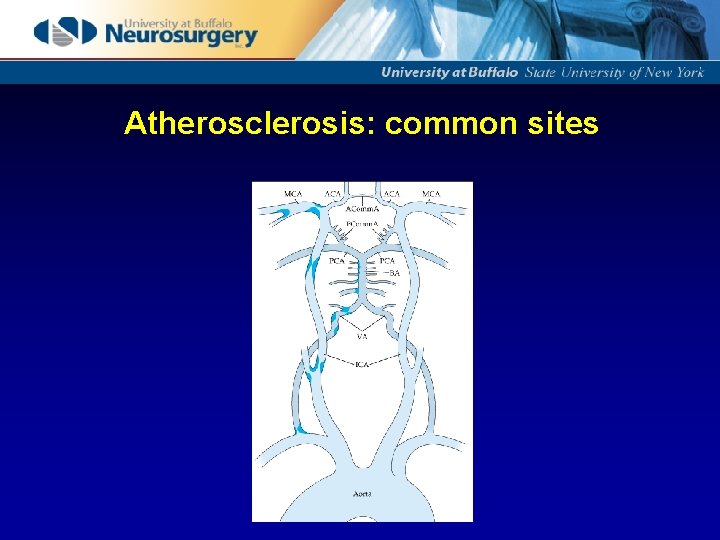 Atherosclerosis: common sites 