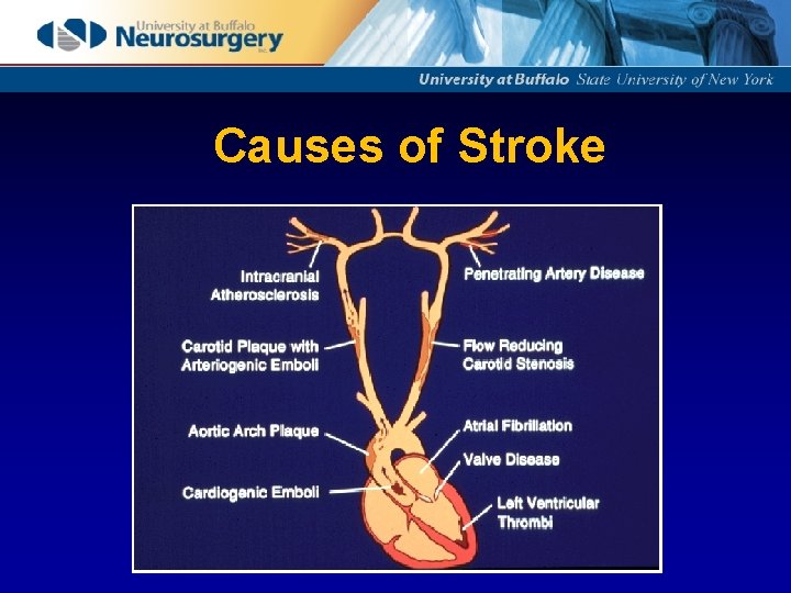 Causes of Stroke 