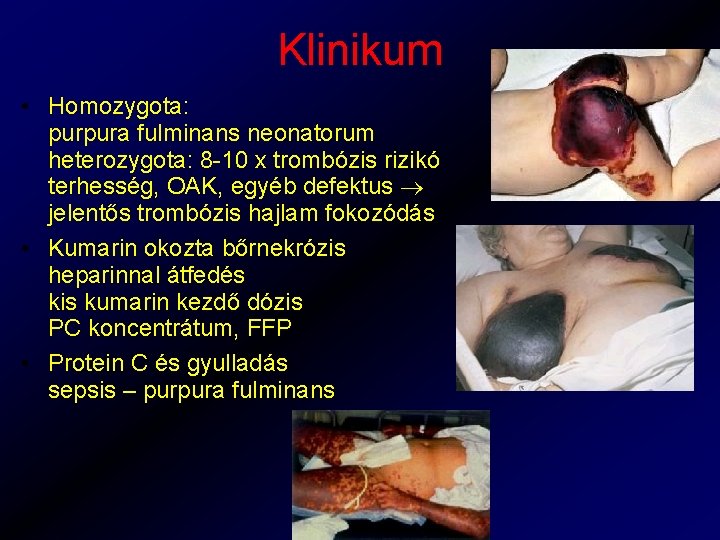 Klinikum • Homozygota: purpura fulminans neonatorum heterozygota: 8 -10 x trombózis rizikó terhesség, OAK,